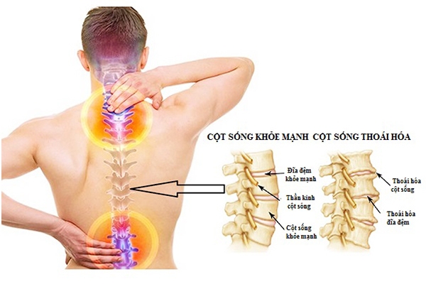 Những biến chứng thoái hóa cột sống cổ, thắt lưng