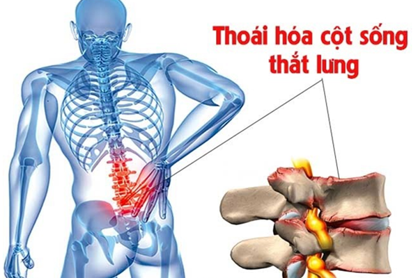 Những biến chứng thoái hóa cột sống cổ, thắt lưng